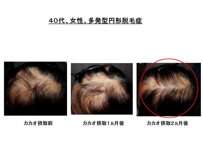円形脱毛症　病院